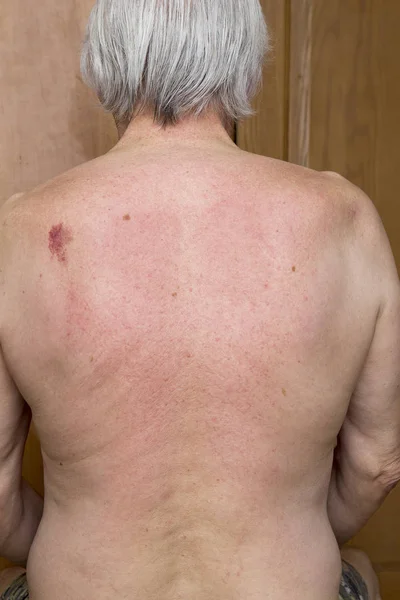 Skin nevus of the back — Stock Photo, Image