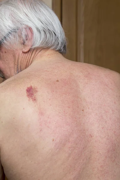 Skin nevus of the back — Stock Photo, Image