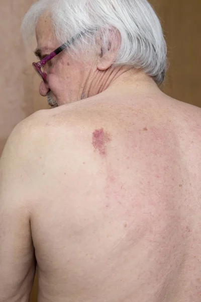 Skin nevus of the back — Stock Photo, Image