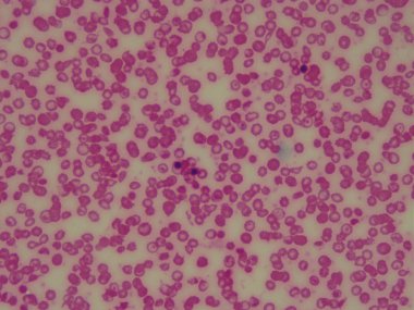sickle cell anemic blood under microscope. Red blood cells. clipart