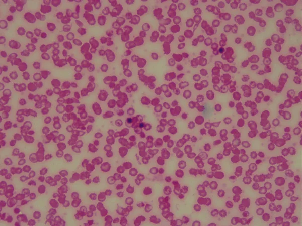 Anemia de células falciformes bajo el microscopio. Glóbulos rojos . —  Fotos de Stock