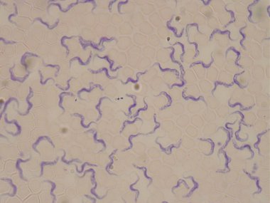 Uyku hastalığı olan bir hastanın kan lekesi. Trypanosoma brucei.