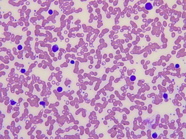 Blood smear of a patient with infections mononucleosis. clipart