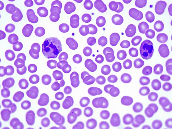 Dois Granulócitos Neutrófilos Segmentados Num Esfregaço Sangue Doente Com Leucemia — Fotografia de Stock