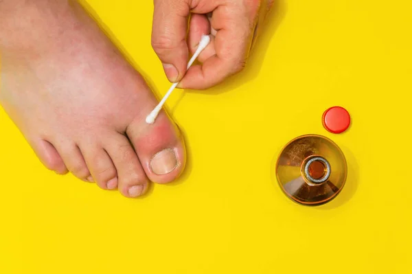 Gout Big Toe Treatment Therapeutic Ointment Top View — Stock Photo, Image