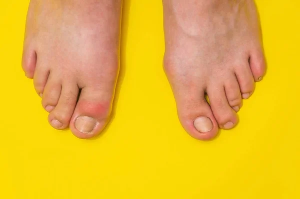 Gout or podagra on the big toe appears as redness and unbearable pain