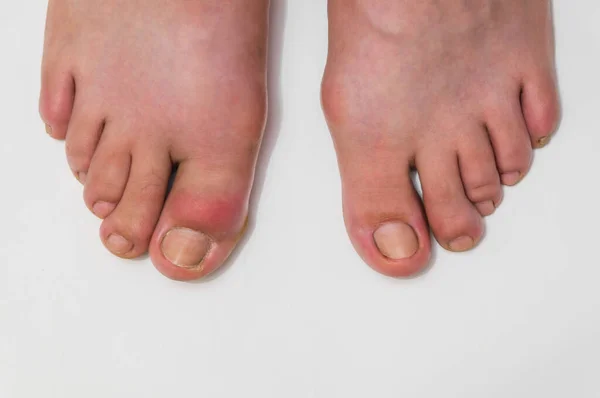 Gout or podagra on the big toe appears as redness and a unbearable pain — Stock Photo, Image