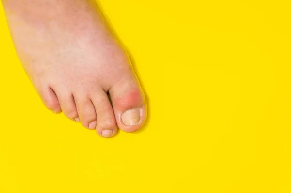Gout on the big toe appears as redness and a unbearable pain — Stock Photo, Image