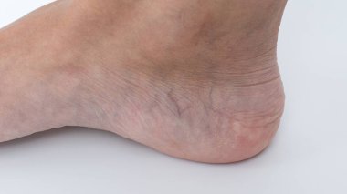 Varicose veins prominently displayed on a woman's leg, highlighting skin texture and condition, illustrating health concerns and circulation issues