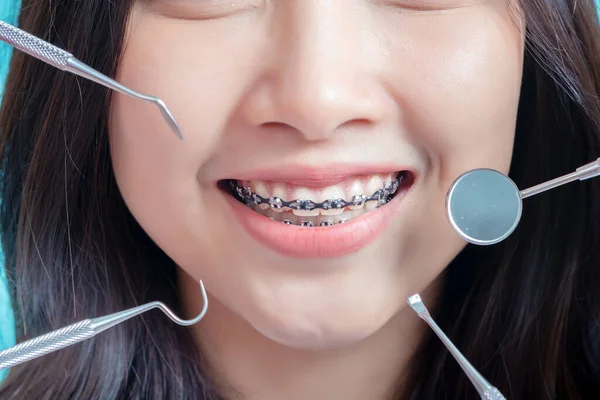 Cerca Los Frenos Dentales Mujer Que Usan Frenos Sonrisa Belleza — Foto de Stock