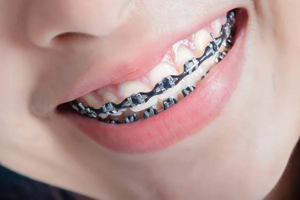 Cerca Los Frenos Dentales Mujer Que Usan Frenos Sonrisa Belleza —  Fotos de Stock