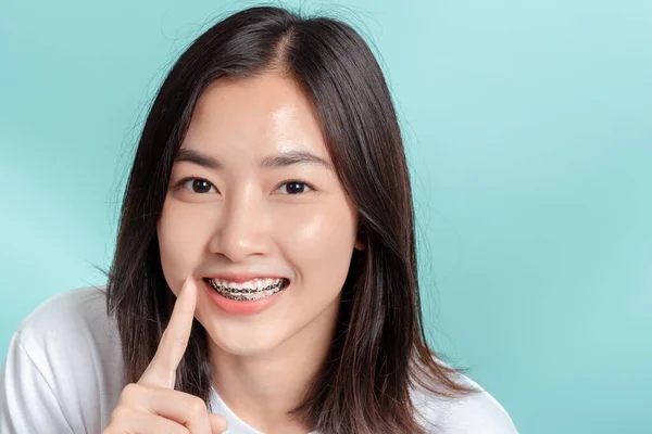 Dental Aparelho Jovem Asiático Mulher Vestindo Aparelho Beleza Sorriso Com — Fotografia de Stock