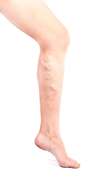 Phlebeurysm nemoc na nohách na bílém pozadí. Křečové žíly — Stock fotografie