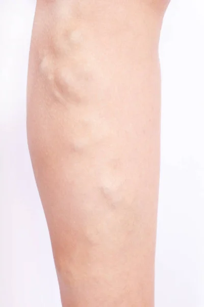 Flebeurisma, venas varicosas en las piernas de cerca — Foto de Stock