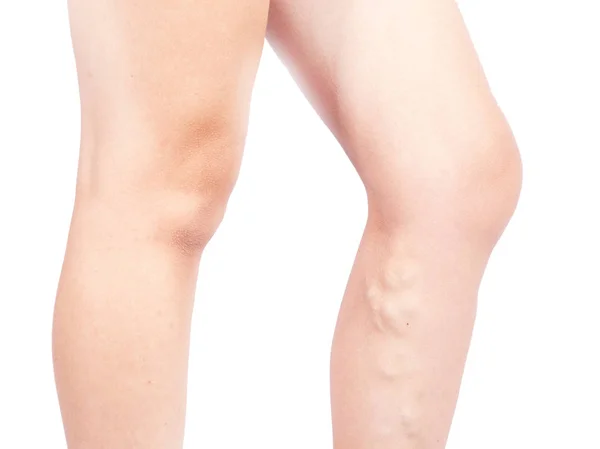 Weibliche Beine mit Krampfadern auf weißem Hintergrund — Stockfoto