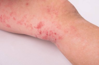 Beyaz arka planda izole edilmiş çocuk bacağında kızarıklık, alerjik reaksiyon, deri iltihabı semptomu.