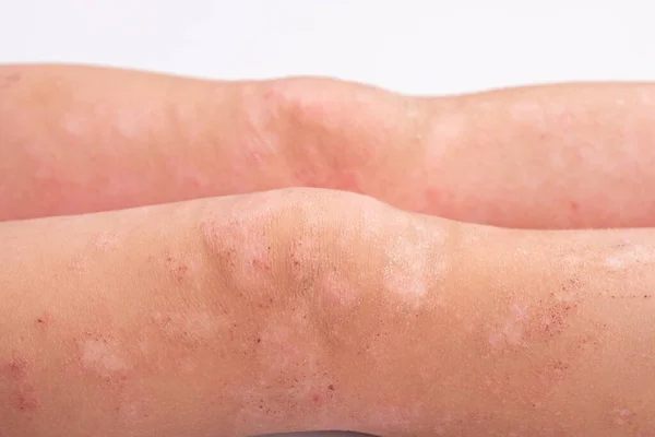 Manifestation von Dermatitis am Körper des Kindes, Hautausschlag an den Beinen aus nächster Nähe, Rötung auf der Haut, allergische Reaktion — Stockfoto