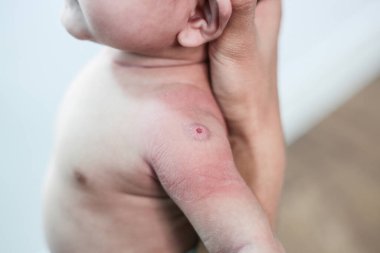 Enjeksiyondan dolayı kırmızı benekli yeni doğmuş bebek.