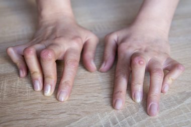 Genç kadının elleri romatoid artrit 'den deforme olmuş..