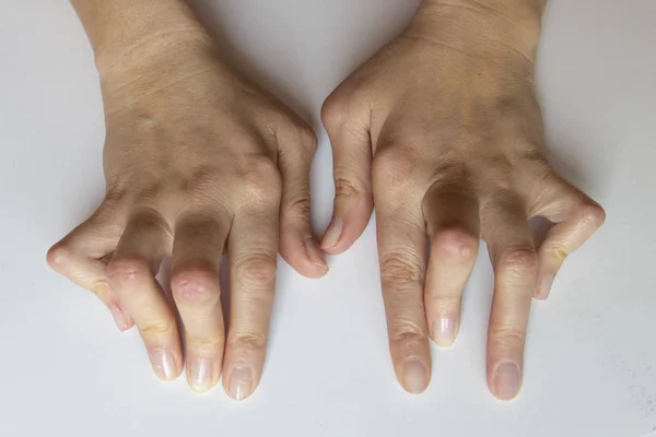 Die Hände der jungen Frau durch rheumatoide Arthritis deformiert. — Stockfoto