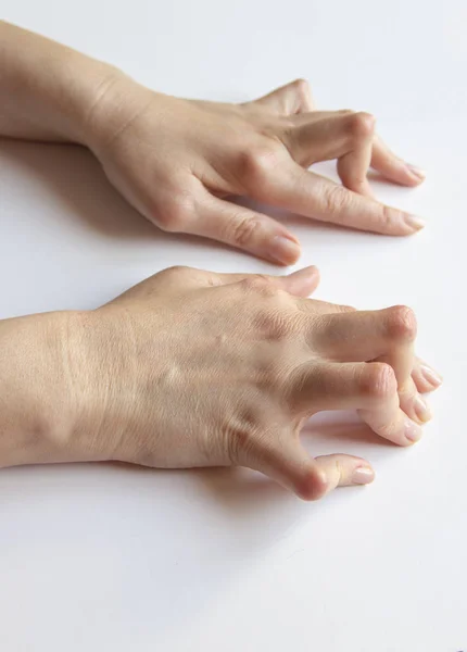Die Hände der jungen Frau durch rheumatoide Arthritis deformiert. — Stockfoto