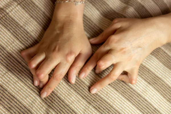 Mujer joven con artritis reumatoide. Las manos y las piernas están deformadas. Siente dolor. Enfoque selectivo . — Foto de Stock