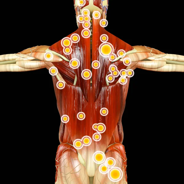 Back view of a man and his trigger points. Anatomy muscles. 3d rendering. Myofascial trigger points, are described as hyperirritable spots in the fascia surrounding skeletal muscle. Palpable nodules in taut bands of muscle fibers.