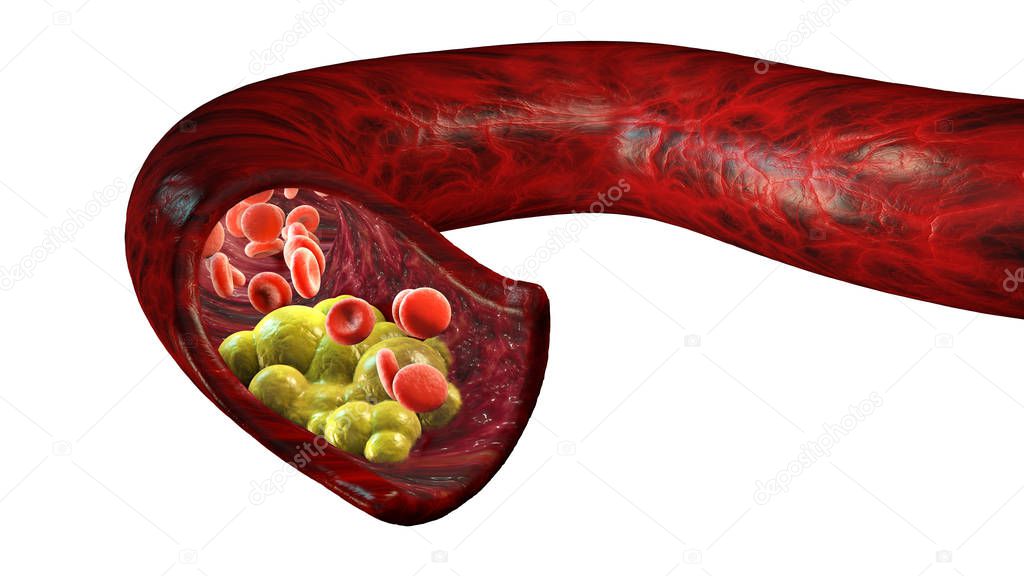 Cholesterol formation, fat, artery, vein, heart. Red blood cells, blood flow. Narrowing of a vein for fat formation