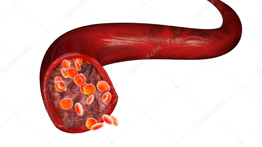 Red blood cells and blood flow through a vein, small spherical cells that contain hemoglobin, a protein that gives a red color to the blood and is able to bind oxygen through the iron inside it. Blood test