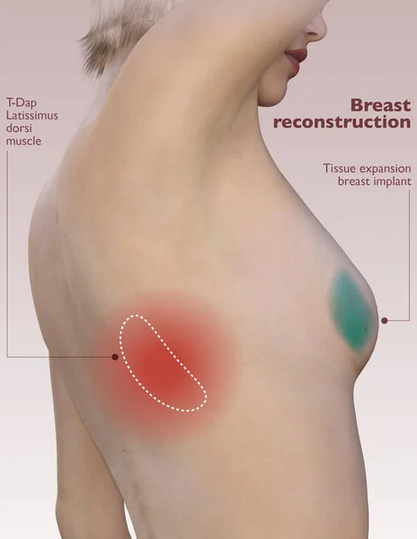 乳房切除後の乳房再建 乳房インプラント再建 再建の種類 レンダリング — ストック写真