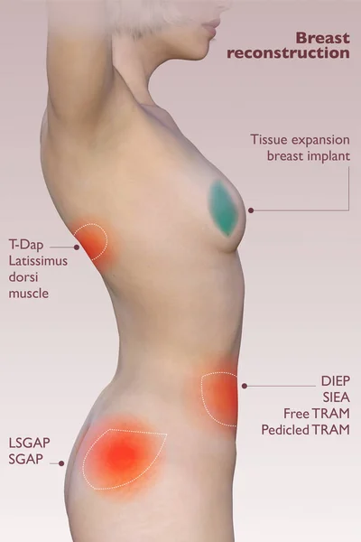 Bröstrekonstruktion Efter Mastektomi Implantat Bröstrekonstruktion Olika Typer Återuppbyggnad Rendering — Stockfoto