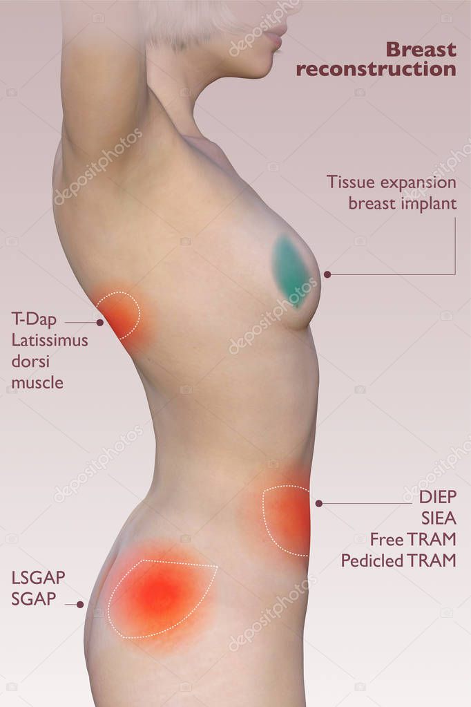 Breast reconstruction after mastectomy, breast implant reconstruction. Different types of reconstruction. 3d rendering