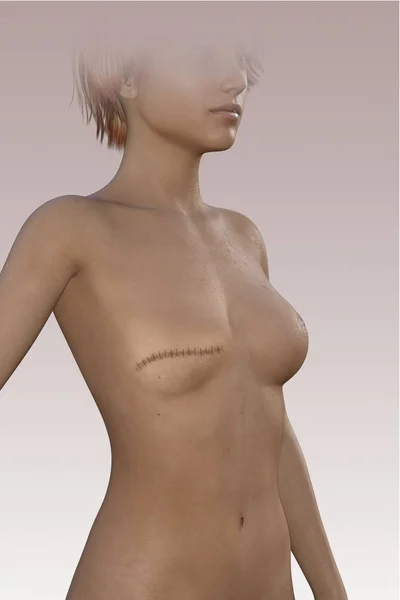 Sonra Bir Mastektomi Meme Olmayan Kadın Vücudunda Yara Izi Mastektomi — Stok fotoğraf