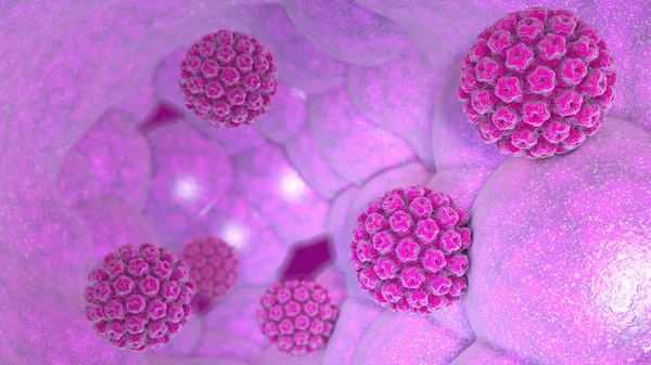 ひと乳頭腫ウイルスの感染症です ウイルス Hpv 最も一般的な性感染症世界です Hpv 感染は ヒトパピ ローマ ウイルス ヒトパピ — ストック写真