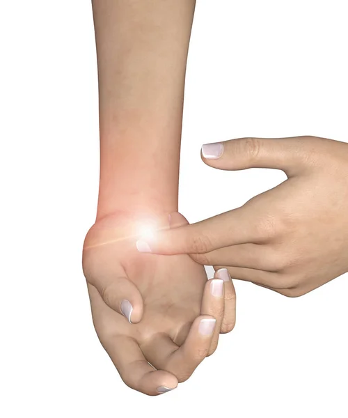 Carpal tunnel syndrome (CTS) is a medical condition due to compression of the median nerve as it travels through the wrist at the carpal tunnel. The main symptoms are pain, numbness and tingling in the thumb, index finger, middle finger