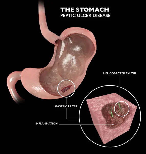 Section 3d of the stomach. Peptic ulcer disease, gastric ulcer is a break in the inner lining of the stomach. Helicobacter pylori is a bacterium usually found in the stomach. Anatomy. 3d rendering