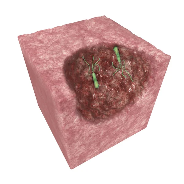 Helicobacter Pylori Una Bacteria Microaerofílica Que Generalmente Encuentra Estómago Está —  Fotos de Stock