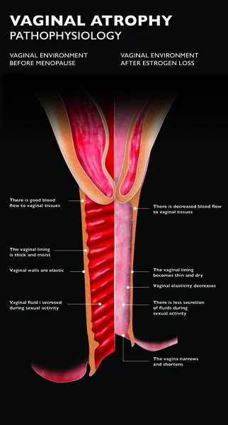 Atrophic vaginitis is inflammation of the vagina as a result of tissue thinning due to not enough estrogen. After menopause the vaginal epithelium changes and becomes a few layers thick. Genitourinary symptoms include