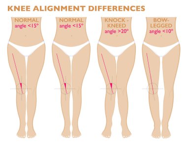 Bacak ve diz, bacak şekilleri farklı açılarını. Önden Görünüm kız, vücudu anatomisi. Normal varus ve valgus