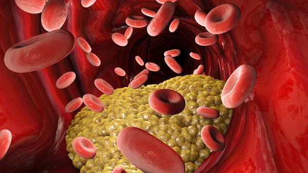 Cholesterinbildung Fett Arterie Vene Herz Rote Blutkörperchen Blutfluss Verengung Einer — Stockfoto