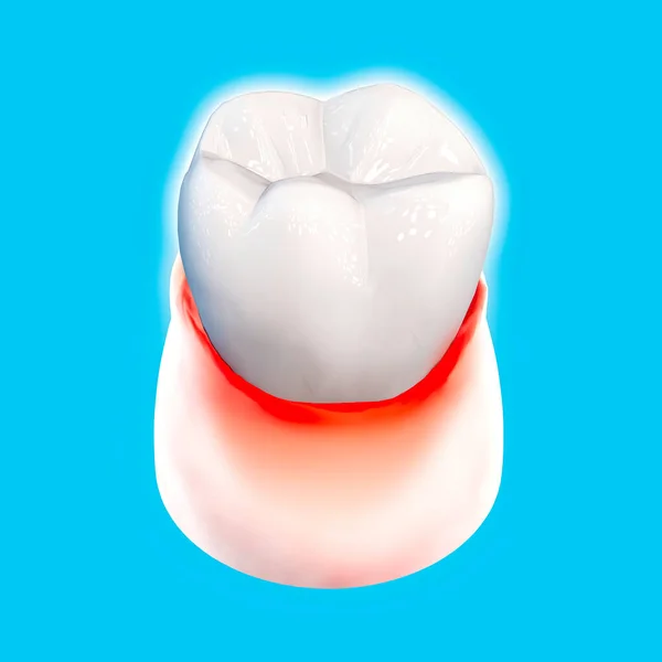 Denti Gengive Doloranti Arrossamenti Odontoiatria Pulizia Dentale Igiene Orale Utilizzando — Foto Stock