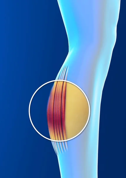 Muscle strain, inflammation of the muscles. Calf. Cramps. Tendons. Contracture. Human body and anatomy, fitness, physical exercises to keep in training. 3d render — Stock Image Muscle Strain Inflammation Muscles Calf Cramps Tendons Contracture Human Body Royalty Free Stock Photos