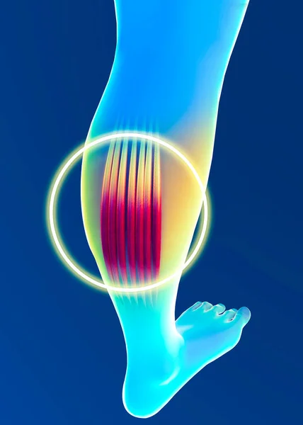 Muscle strain, inflammation of the muscles. Calf. Cramps. Tendons. Contracture. Human body and anatomy, fitness, physical exercises to keep in training. 3d render — Stock Image Muscle Strain Inflammation Muscles Calf Cramps Tendons Contracture Human Body Stock Photo