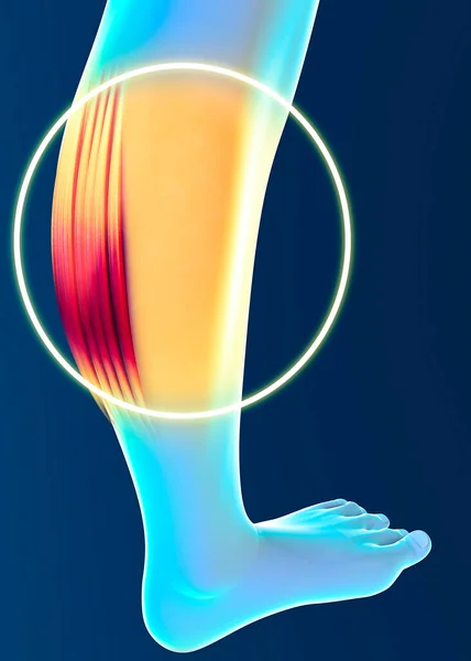 Muscle strain, inflammation of the muscles. Calf. Cramps. Tendons. Contracture. Human body and anatomy, fitness, physical exercises to keep in training. 3d render — Stock Image Muscle Strain Inflammation Muscles Calf Cramps Tendons Contracture Human Body Stock Picture