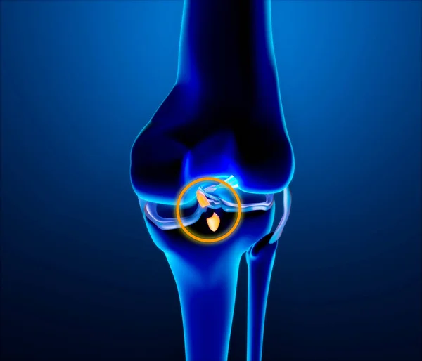 Broken Posterior Cruciate Ligament Injury Rupture Enlargement Bones Knee Femur — Stock Photo, Image