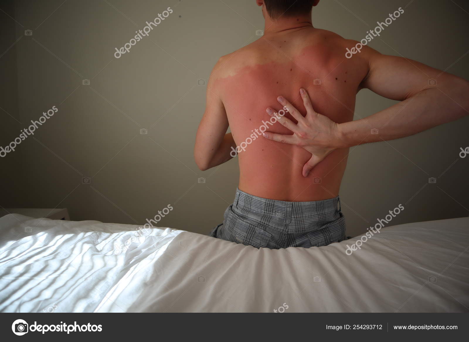 Burned Back Man Reddened Itchy Skin Sunburn Skin Care Protection — Stock Photo © nycowl 254293712