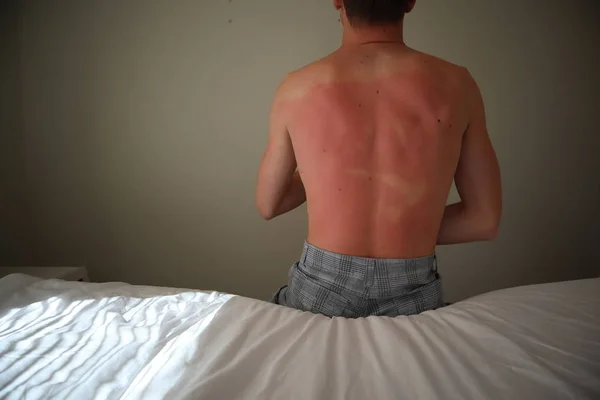 burned back. A man with reddened, itchy skin after sunburn. Skin care and protection from the sun's ultraviolet rays. Man with sunburned skin.