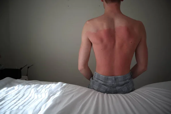 burned back. A man with reddened, itchy skin after sunburn. Skin care and protection from the sun's ultraviolet rays. Man with sunburned skin.