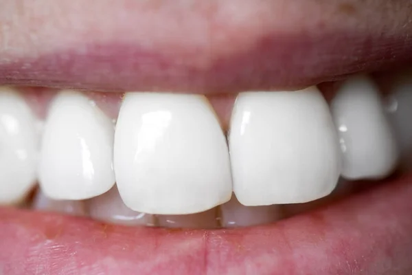 치아를 여자의 클로즈업 — 스톡 사진