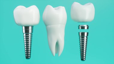 Tooth implant disassembled -- 3D Rendering clipart